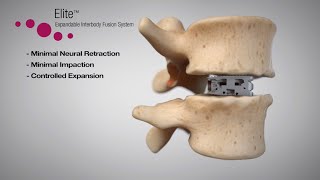 Elite™ Expandable Interbody Fusion System Animation [upl. by Aiciled]