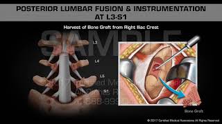 Posterior Lumbar Fusion amp Instrumentation at L3S1 [upl. by Annaeed472]