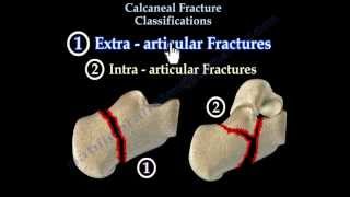 Calcaneal Fracture Classifications  Everything You Need To Know  Dr Nabil Ebraheim [upl. by Ianteen]