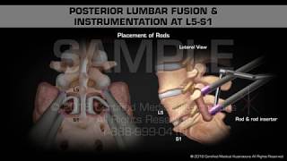 Posterior Lumbar Fusion amp Instrumentation at L5S1 [upl. by Egroej966]