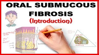 Oral Submucous Fibrosis OSMF Introduction [upl. by Ihdin]