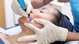 Microneedling Full Training Video [upl. by Anilorak]