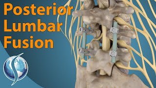 Posterior Lumbar Fusion [upl. by Ennayr]