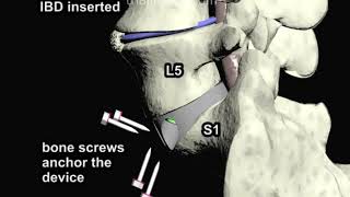 Anterior Lumbar Interbody Fusion ALIF Part 3 Animation by Cal Shipley MD [upl. by Etep]