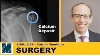 Calcific tendinitis of the shoulder [upl. by Anez]