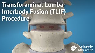 Transforaminal Lumbar Interbody Fusion TLIF Procedure [upl. by Ahsenac495]