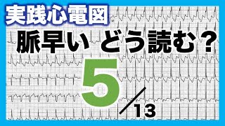 【心電図 読み方 ⑤】頻脈 Tachycardia PSVT 心房頻拍AT 心房粗動AFL [upl. by Nwahsirhc893]