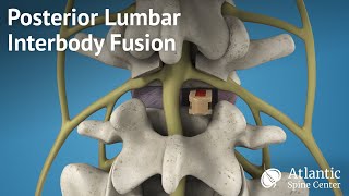 Posterior Lumbar Interbody Fusion PLIF [upl. by Booth]