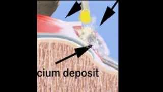 Calcium Removal [upl. by Carson]