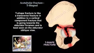 Acetabulum fracture anatomy OTA lecture series III v04a [upl. by Ainerbas]