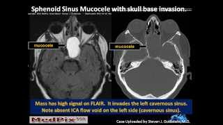 Cough 101 An Overview of Cough in Pulmonary Fibrosis [upl. by Llenyt887]