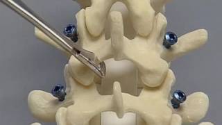 Posterior Lumbar Interbody Fusion PLIF spine surgery [upl. by Prendergast175]