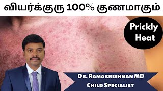 Prickly Heat Home Remedies  Top 10 Tips To Cure Heat Rash Miliaria Rubra  Dr Ramakrishnan MD [upl. by Cooke774]