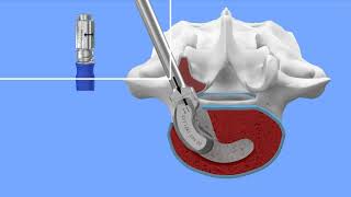 Double Medical Transforaminal Lumbar Interbody Fusion Cage TLIF [upl. by Uhp711]