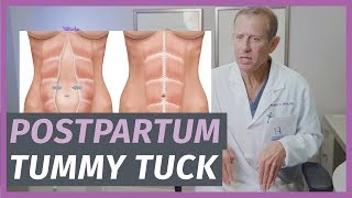 Postpartum Tummy Tucks Everything You Need To Know [upl. by Aluor142]