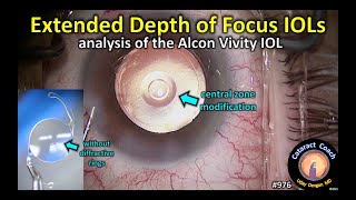 Extended Depth of Focus IOLs EDOF Lens for cataract surgery  Alcon Vivity [upl. by Mlohsihc97]