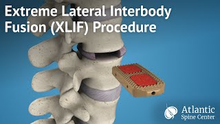 Extreme Lateral Interbody Fusion XLIF Procedure [upl. by Bandler810]