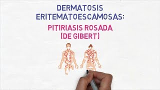 Dermatología  Pitiriasis Rosada de Gibert o de Gilbert [upl. by Hildebrandt]