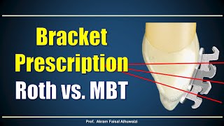 Using Roth and MBT brackets [upl. by Hamilah960]