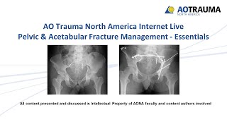 Acetabular Fracture Associated BOTH Columns  Everything You Need To Know  Dr Nabil Ebraheim [upl. by Kere979]