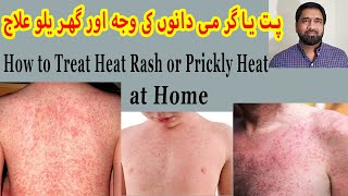 Prickly Heat Treatment  Skin Rash  Red Skin Rash  Miliaria Rubra  Itchy Rash  Sun Allergy [upl. by Aydne]