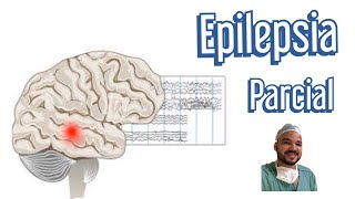 Crise Focal Epilepsia [upl. by Anha194]