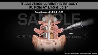 Transverse Lumbar Interbody Fusion at L45 amp L5S1  Medical Animation [upl. by Eemyaj]