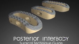 Posterior Interbody Surgical Technique Guide [upl. by Eeleimaj478]